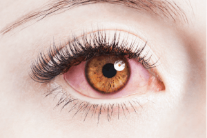 Ojos rojos de una persona debido al escozor
