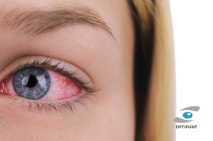 Mujer con ojos rojos debido a la alergia ocular