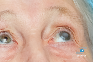 Mujer mayor con catarata en ojo derecho