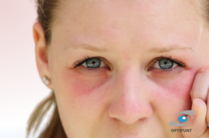 Mujer joven con síntomas de alergia ocular,