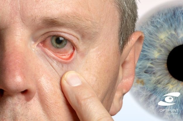 La deformación de la córnea puede comenzar con síntomas muy sutiles, pero si se detecta a tiempo, es posible corregir o controlar el problema antes de que limite tu calidad de vida.