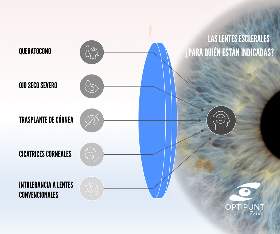 Indicaciones de las lentes esclerales en queratocono, ojo seco severo, trasplante de córnea y cicatrices corneales